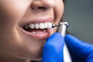 close up of teeth cleaning in Upper Kirby Texas during polishing