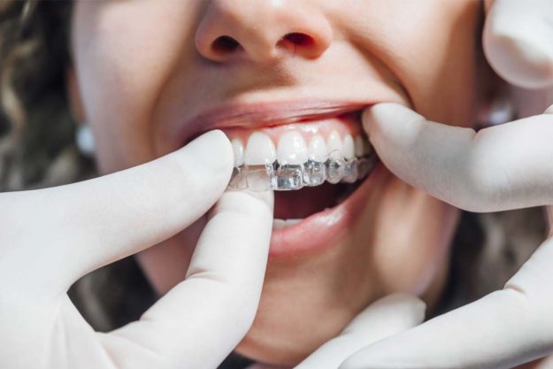 invisalign (1) patient being fitted for Invisalign