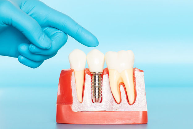 What-Are-Dental-Implants a dentist points to a sample of dental implants