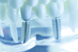 an example of dental implants 