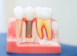 example of single tooth implant