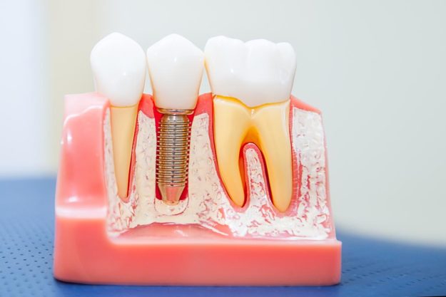 What is a Single Tooth Implant (2) example of single tooth implant