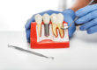 benefits of dental implants