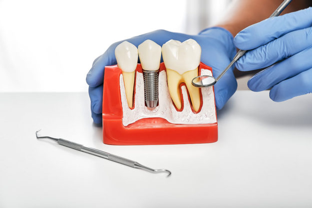 4-Benefits-of-Dental-Implants benefits of dental implants