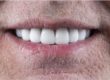 a man flashes his dental veneers