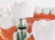 a photo of teeth represents dental implants