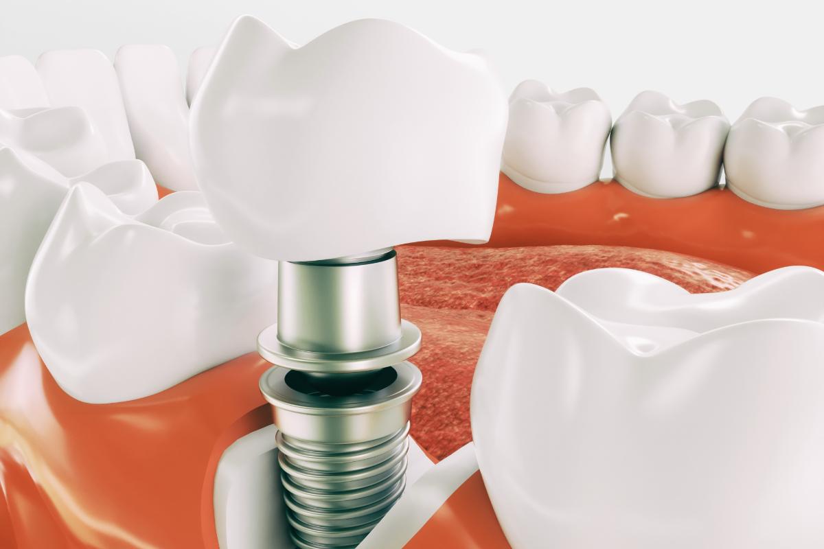 a photo of teeth represents dental implants